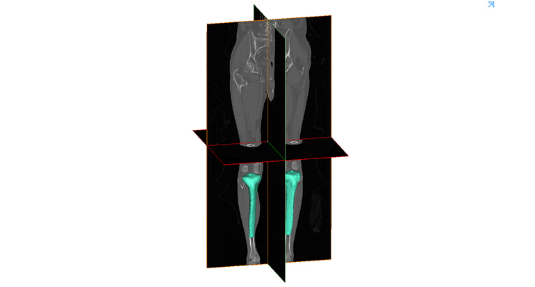 IBV investiga en productos y servicios sanitarios para el tratamiento de enfermedades osteoarticulares con Inteligencia Artificial y 3D