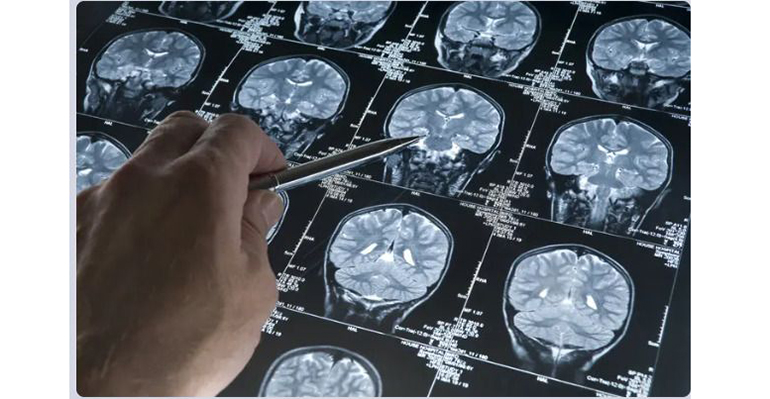 IQS analiza cómo la diabetes influye en el deterioro cognitivo y el Alzheimer