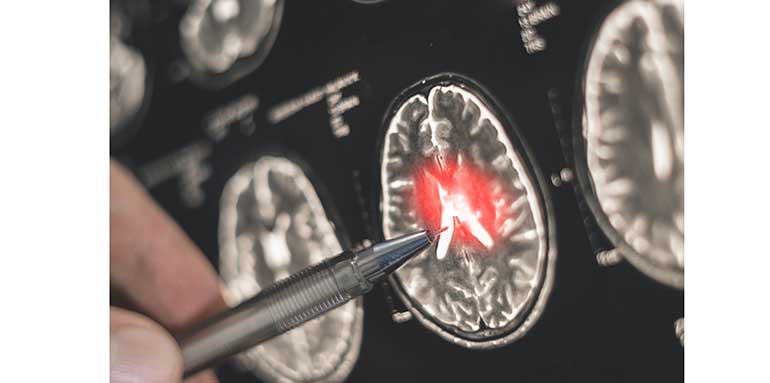 -avances-en-biomarcadores-biotecnologia-transforman-abordaje-esclerosis-multiple