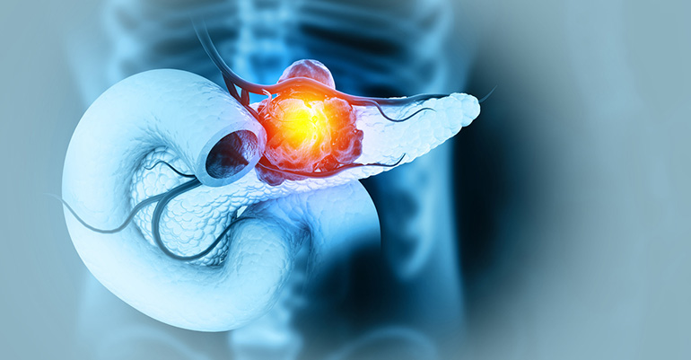 El Centro de Investigación del Cáncer de Salamanca lidera un estudio acerca de una nueva terapia dirigida contra el cáncer de páncreas 