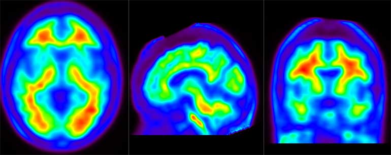Lilly muestra la eficacia de donanemab en la reducción de la progresión del deterioro cognitivo y funcional en fases tempranas del Alzheimer